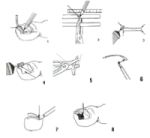 Onyclip – System korekcji paznokcia Onyclip – System korekcji paznokcia
