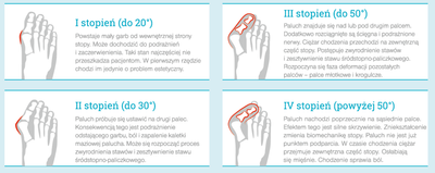 Profilaktyka Hallux Valgus - opaska korekcyjna, 43-47, 2 szt.