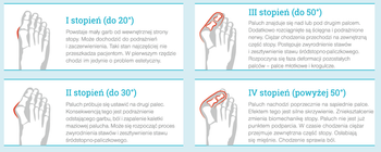Profilaktyka Hallux Valgus - opaska korekcyjna, 43-47, 2 szt.