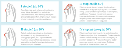 Profilaktyka Hallux Valgus - opaska korekcyjna, 34-42, 2 szt.